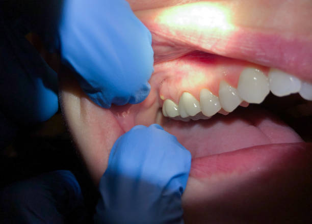 Best Broken Tooth Emergency  in Lake Mills, WI